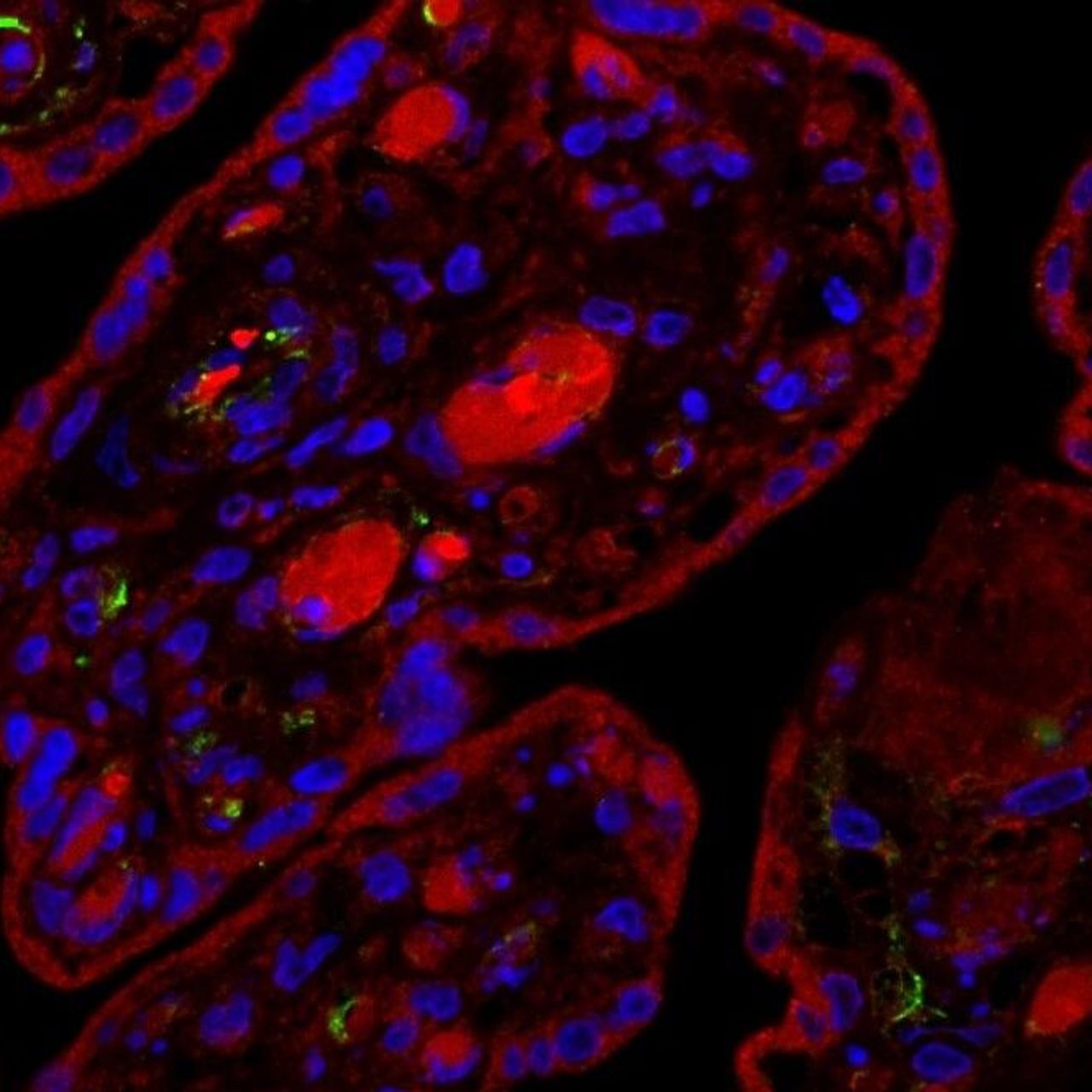 感染 SARS-CoV-2 的人類胎盤切片，並在感染 24 小時後進行分析：綠色信號表示存在 Spike 病毒蛋白，藍色信號表示胎盤組織中的細胞核