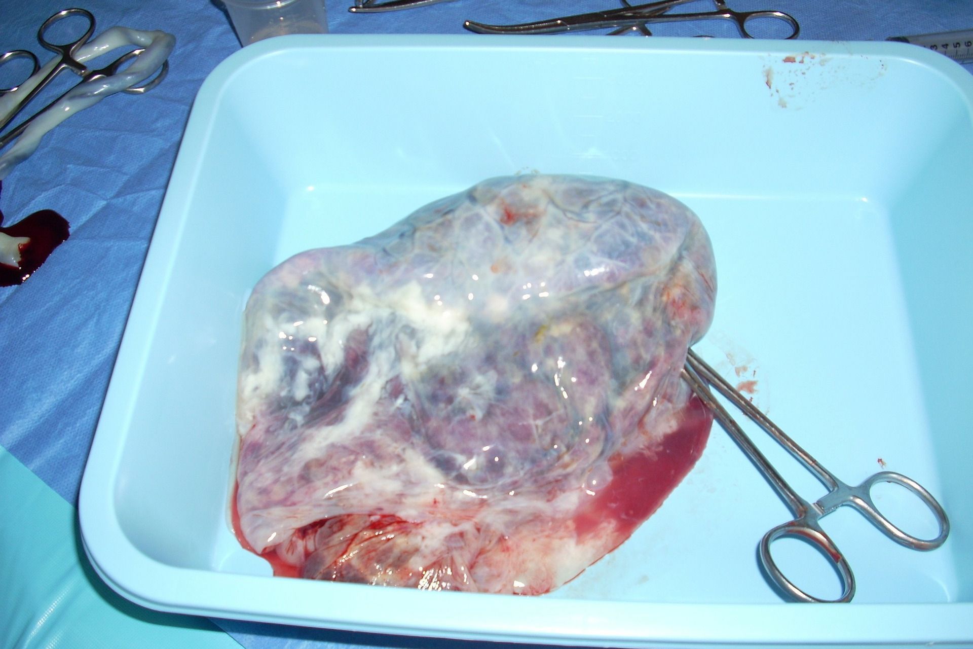 Una placenta umana adagiata in un vassoio chirurgico