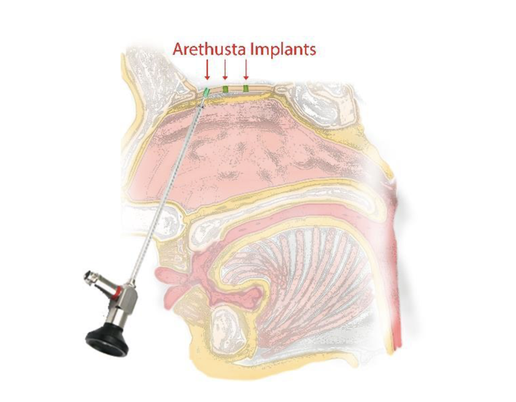 Имплантот Arethusta дизајниран од Leucadia Therapeutics за промовирање на „одливот на трици“ и спречување на Алцхајмерова болест