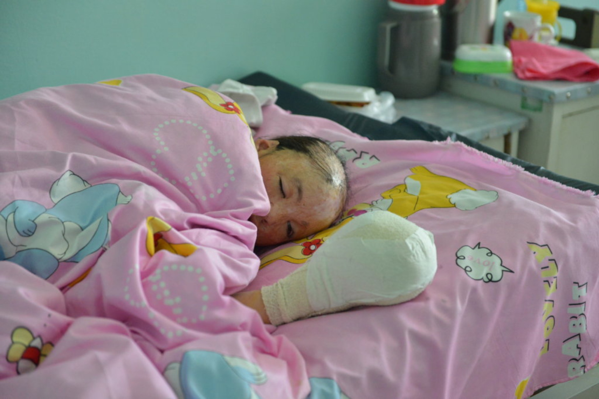 Un bambino vittima di ustioni al volto in Mongolia, per il quale l’associazione Global Giving ha raccolto fondi su Internet (Foto: globalgiving.org)