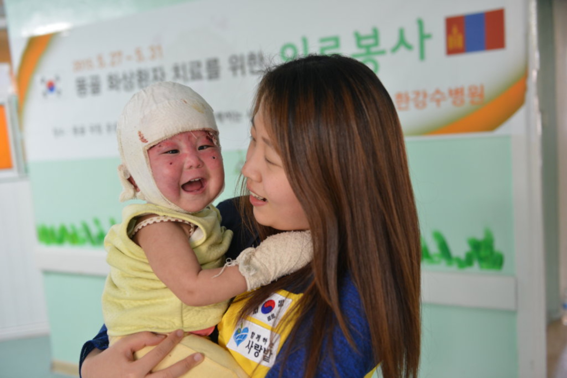 Un bambino vittima di ustioni al volto in Mongolia, per il quale l’associazione Global Giving ha raccolto fondi su Internet (Foto: globalgiving.org)