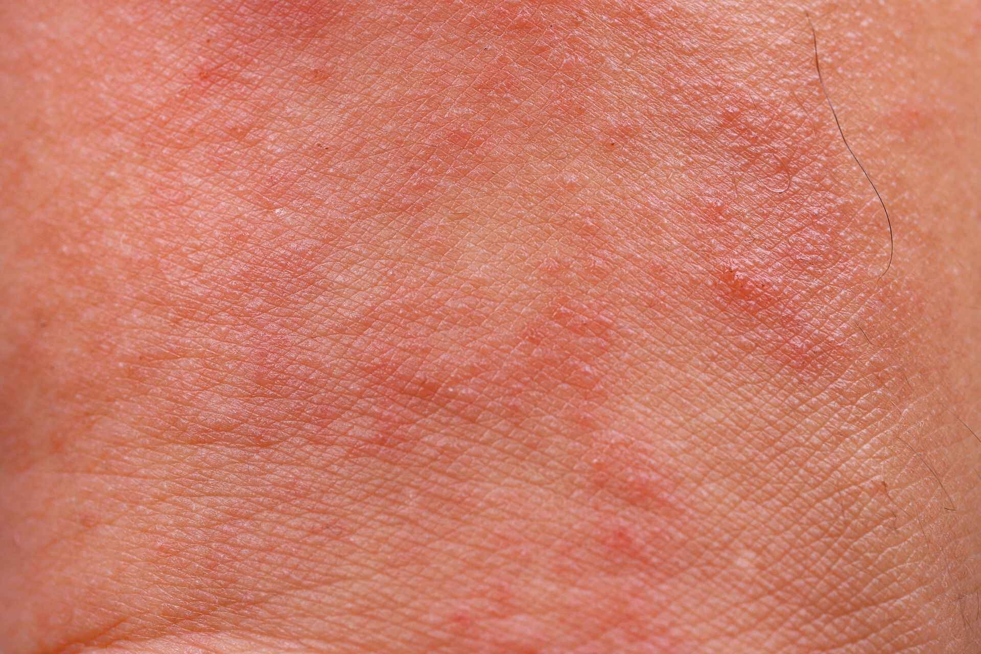 Dermatite: in natura esistono diverse tipologie di dermatite e spesso non se ne comprende la causa