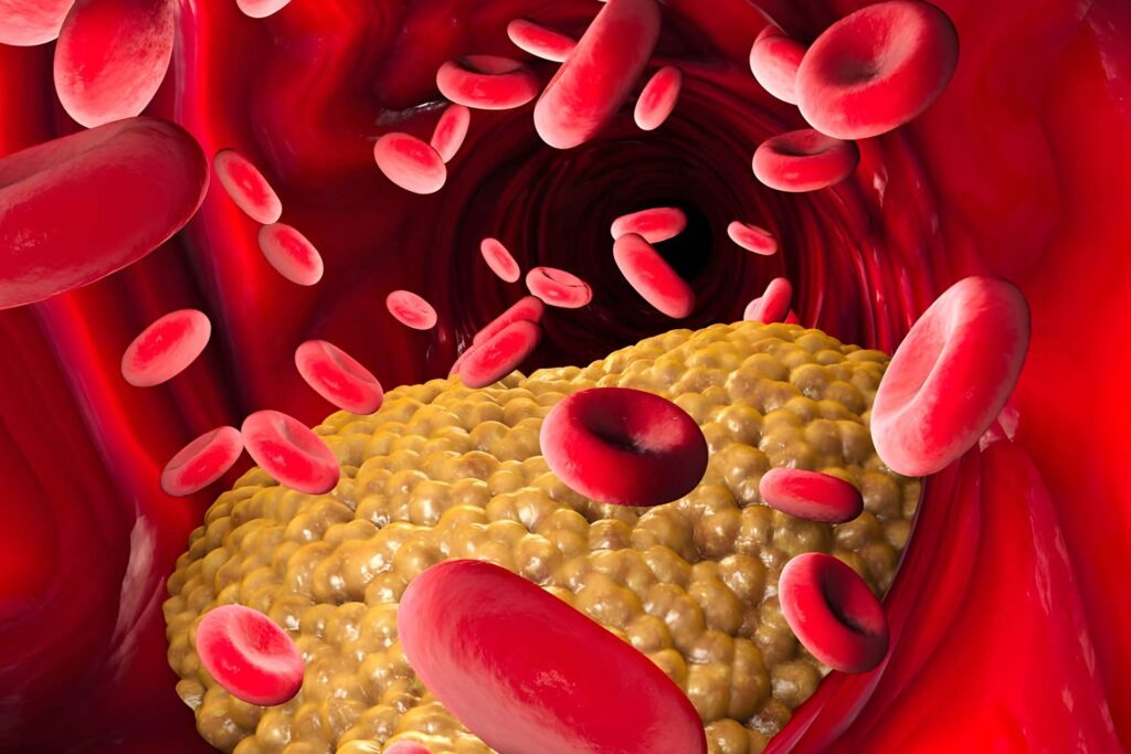 Kolesterol: det onda kolesterolet kommer från triglycerider