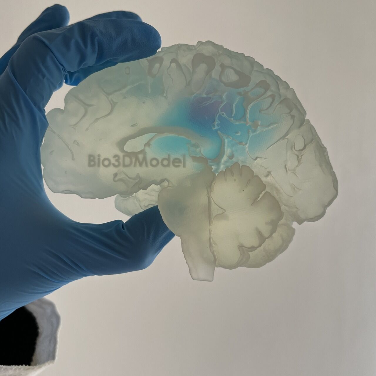 Cervello umano: la riproduzione di un cervello affetto da metastasi e stampato in 3D dalla società italiana Bio3DModel