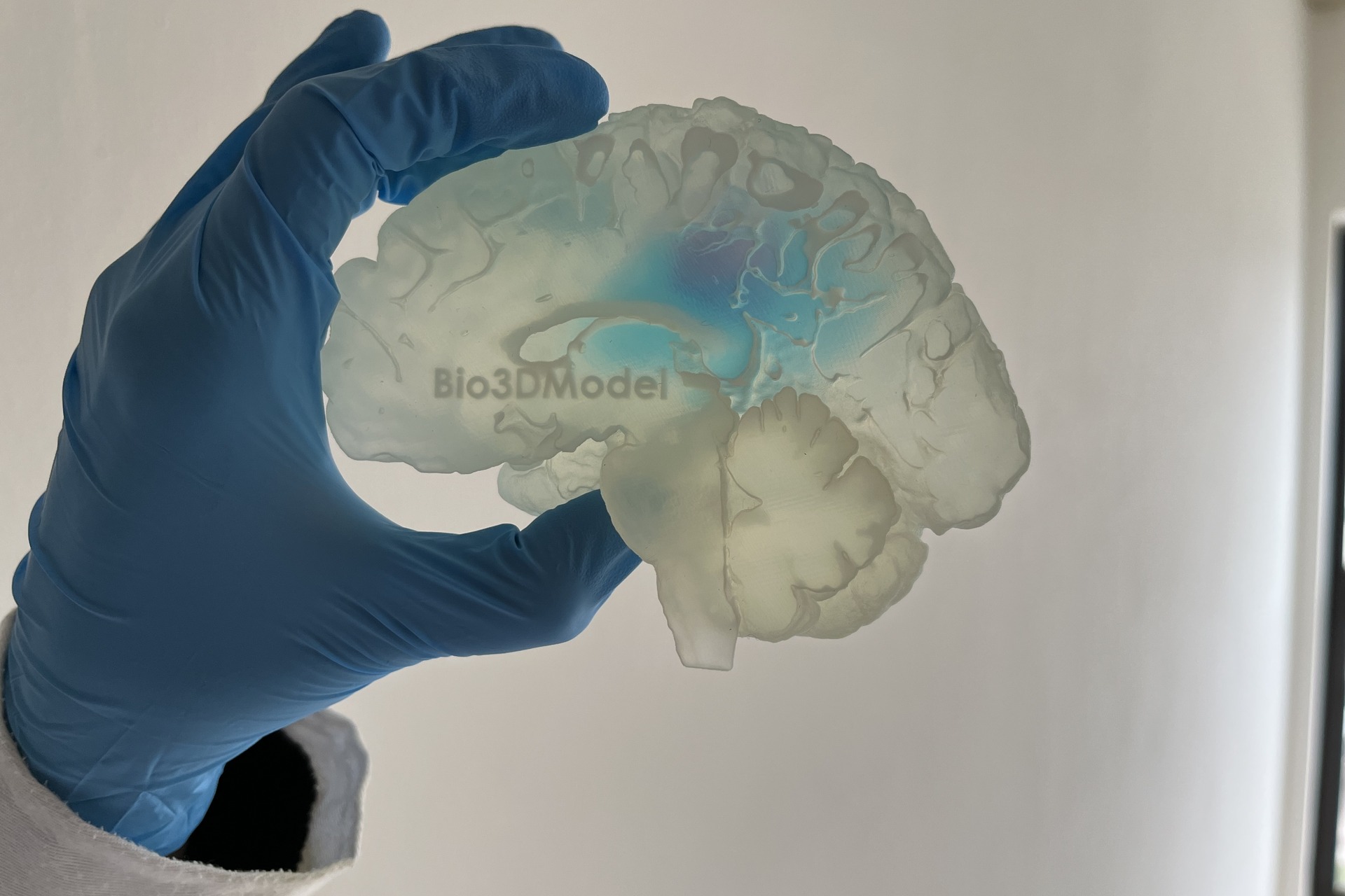 Чалавечы мозг: рэпрадукцыя мозгу, здзіўленага метастазамі, надрукаваная ў 3D італьянскай кампаніяй Bio3DModel